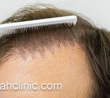 کاشت مو با جدیدترین روش | فرح کلینیک