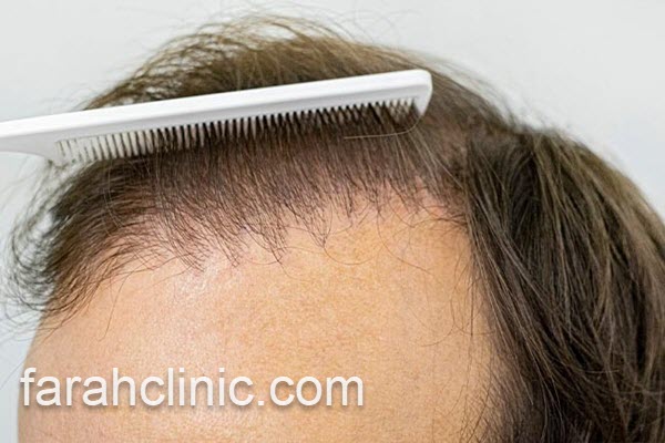 کاشت مو با جدیدترین روش | فرح کلینیک