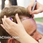 روش جدید کاشت مو در غرب تهران