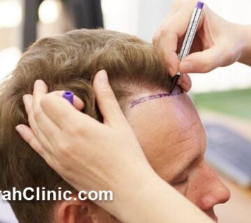 روش جدید کاشت مو در غرب تهران