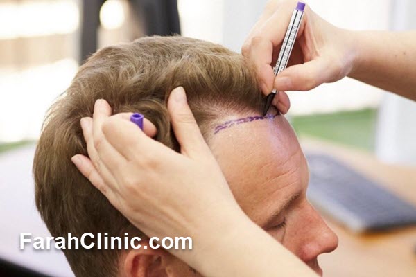 روش جدید کاشت مو در غرب تهران