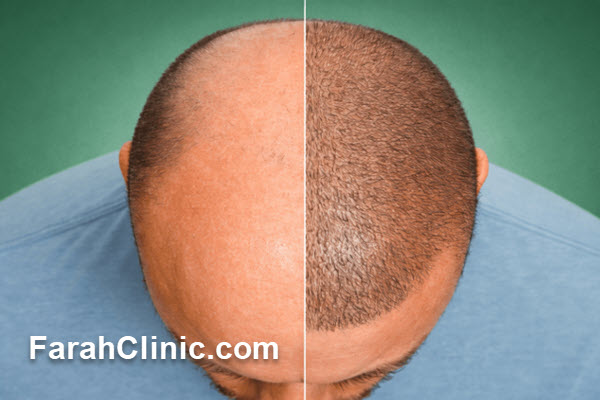اهمیت تخصص و تجربه پزشک در کاشت مو